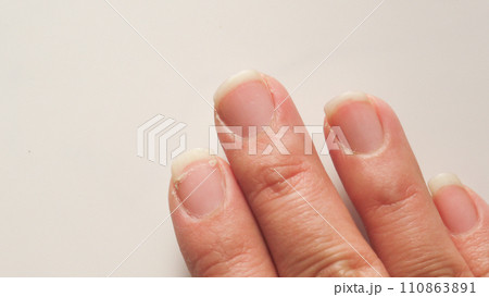爪がひび割れてしまった手 110863891