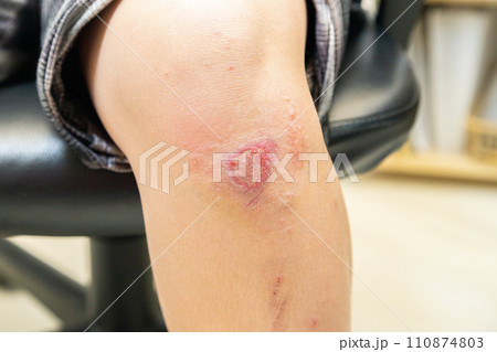 けがをしている女性の膝 110874803