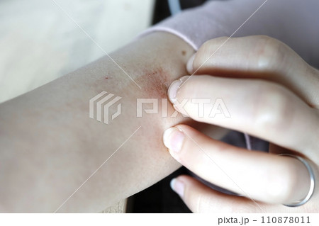 冬場に乾燥した上腕部外側を掻きむった傷 110878011