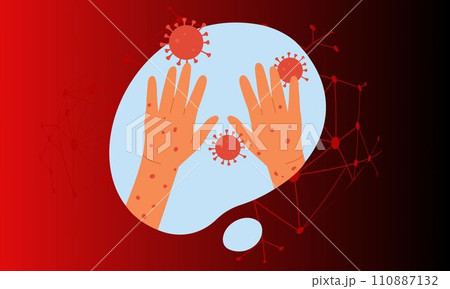 Monkeypox virus banner for awareness and alert against disease spread, symptoms or precautions. Monkey Pox virus outbreak pandemic design with microscopic view background 110887132