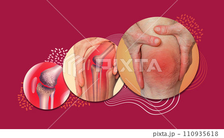 Acute pain in a knee joint, close-up. Color image, isolated on a pastel background. Pain area of red color Acute pain in a knee joint, close-up. Color image, isolated on a pastel background. Pain area of red color 110935618