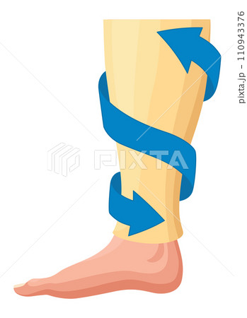 Stages or types of varicose veins development. Medical poster or disease infographic. Image of diseased legs. Vector illustration in flat style 110943376