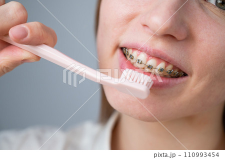 Portrait of a caucasian woman with braces on her teeth holding a toothbrush. Portrait of a caucasian woman with braces on her teeth holding a toothbrush. 110993454