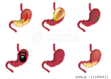 Stomach diseases set 111006411