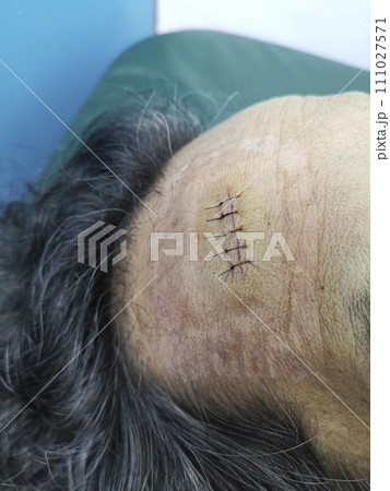 Stitched wound in forehead area from accident Stitched wound in forehead area from accident 111027571