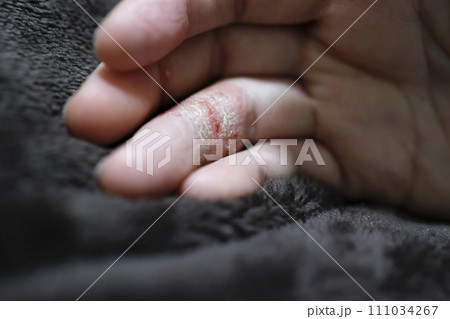 手湿疹で荒れた女性の指 111034267
