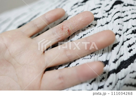 手湿疹で荒れた女性の指 111034268