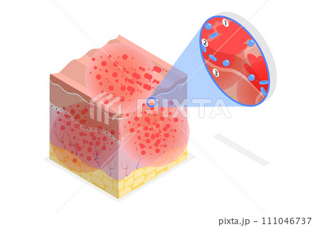 3D Isometric Flat  Conceptual Illustration of Atopic Dermatitis 111046737