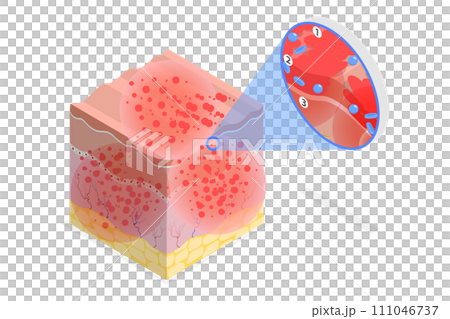3D Isometric Flat  Conceptual Illustration of Atopic Dermatitis 111046737