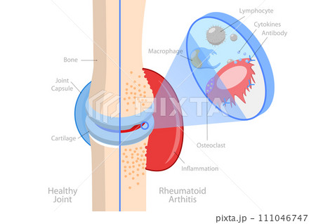 3D Isometric Flat  Conceptual Illustration of Rheumatoid Arthritis 111046747