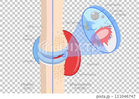 3D Isometric Flat  Conceptual Illustration of Rheumatoid Arthritis 111046747