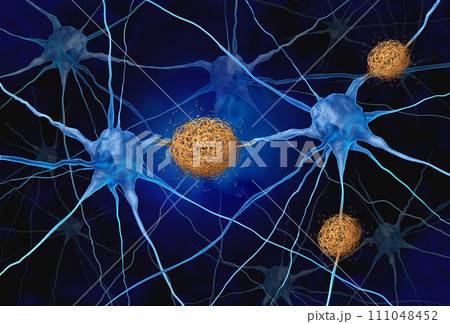 Amyloid Plaques Amyloid Plaques 111048452