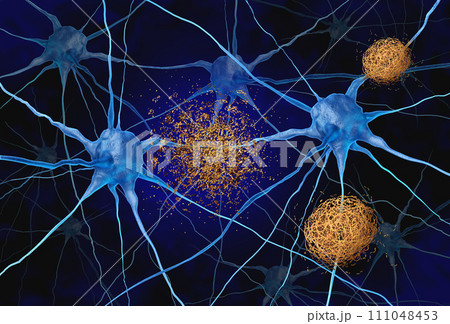 Amyloid Targeted Therapy Amyloid Targeted Therapy 111048453