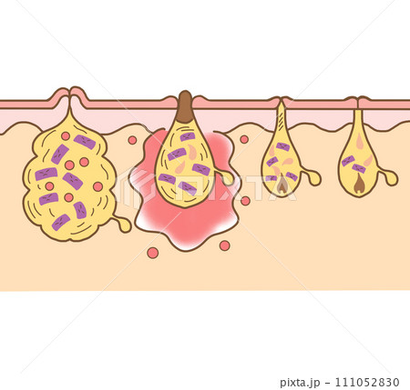 ニキビのイラスト ニキビの図 文字なし 皮膚科 皮膚病 尋常性ざ瘡 病気 皮膚疾患 膿疱 できもの ニキビのイラスト ニキビの図 文字なし 皮膚科 皮膚病 尋常性ざ瘡 病気 皮膚疾患 膿疱 できもの 111052830