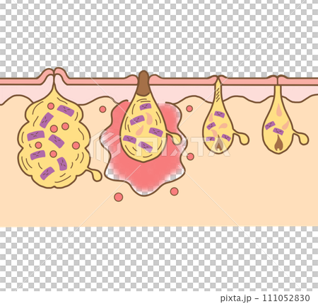 ニキビのイラスト ニキビの図 文字なし 皮膚科 皮膚病 尋常性ざ瘡 病気 皮膚疾患 膿疱 できもの ニキビのイラスト ニキビの図 文字なし 皮膚科 皮膚病 尋常性ざ瘡 病気 皮膚疾患 膿疱 できもの 111052830