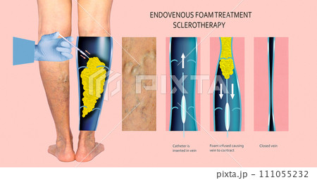 Endovenous laser treatment for varicose veins - foam sclerotherapy concept. 111055232