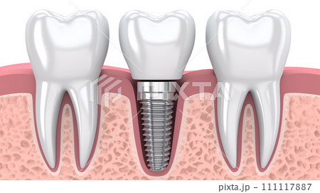 歯とインプラントのイラスト 歯とインプラントのイラスト 111117887