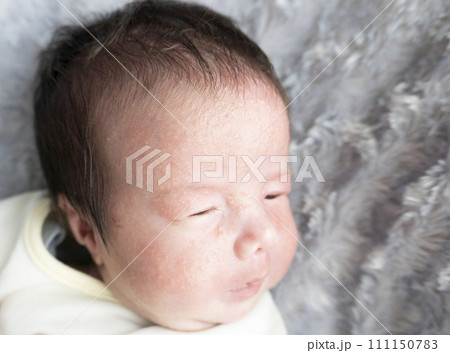 新生児の乳児湿疹 新生児の乳児湿疹 111150783