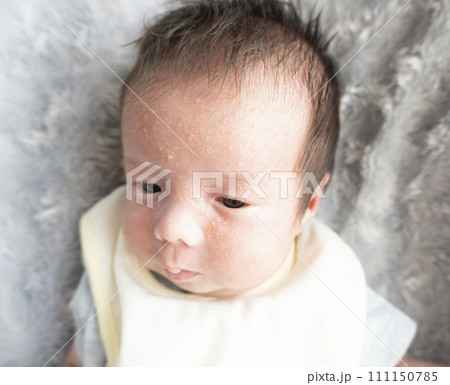新生児の乳児湿疹 新生児の乳児湿疹 111150785