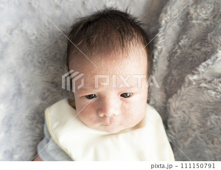 新生児の乳児湿疹 111150791