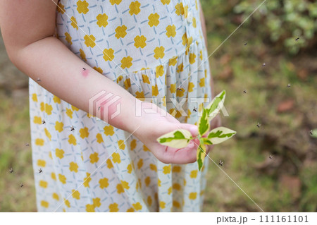 Little girl has skin rash allergy itching and scratching on her arm with mosquitoes bite 111161101