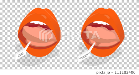 3D Isometric Flat  Conceptual Illustration of Ankyloglossia 111182400