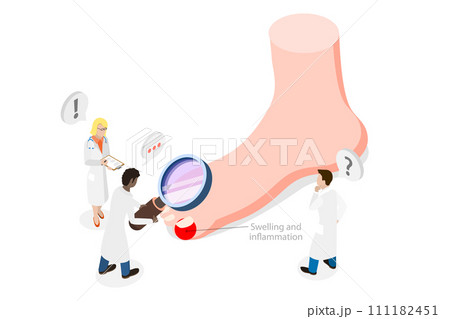 3D Isometric Flat  Conceptual Illustration of Ingrown Toenail 111182451