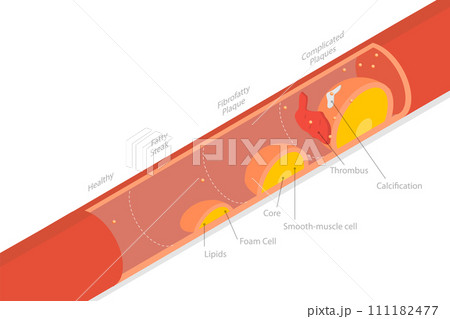 3D Isometric Flat  Conceptual Illustration of Stage Of Atherosclerosis 111182477