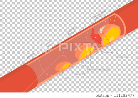 3D Isometric Flat  Conceptual Illustration of Stage Of Atherosclerosis 111182477