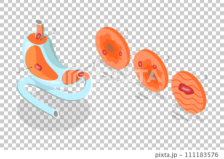 3D Isometric Flat  Conceptual Illustration of Peptic Ulcer Stomach Disease, Gastritis and Inflammation 111183576
