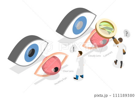 3D Isometric Flat  Conceptual Illustration of Cataract 111189380