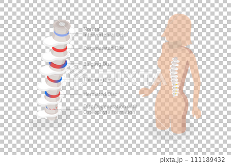 3D Isometric Flat  Conceptual Illustration of Degenerative Disc Disease 111189432