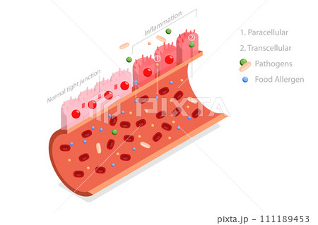 3D Isometric Flat  Conceptual Illustration of Leaky Gut Syndrome 111189453