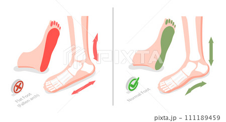 3D Isometric Flat  Conceptual Illustration of Flat Foot 111189459