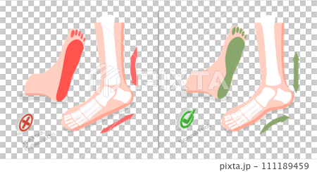 3D Isometric Flat  Conceptual Illustration of Flat Foot 111189459