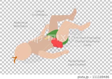 3D Isometric Flat  Conceptual Illustration of Gastroschisis 111189486