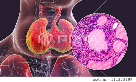 Toxic goiter, 3D illustration and micrograph 111228194