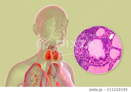 Toxic goiter, 3D illustration and micrograph Toxic goiter, 3D illustration and micrograph 111228195