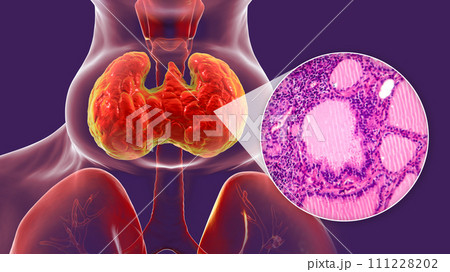 Toxic goiter, 3D illustration and micrograph Toxic goiter, 3D illustration and micrograph 111228202