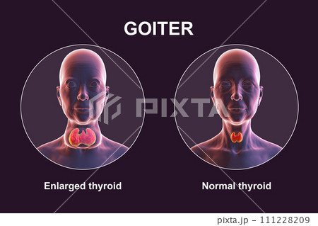 Enlarged thyroid gland, 3D illustration Enlarged thyroid gland, 3D illustration 111228209