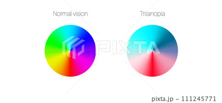 Tritanopia and tritanomaly 111245771