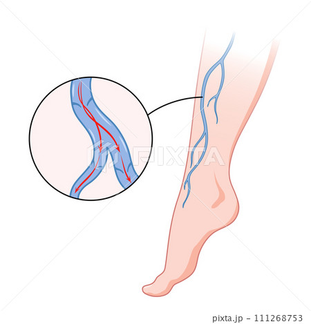Varicose veins. Blue blood vessel visible through the skin, abnormally swollen leg. Vascular disease diagnostic and treatment. Venous insufficiency medical disease Varicose veins. Blue blood vessel visible through the skin, abnormally swollen leg. Vascular disease diagnostic and treatment. Venous insufficiency medical disease 111268753