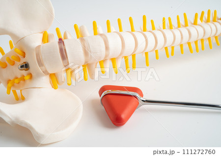 Human spinal nerve and bone with percussion reflex hammer, model for treatment medical in the orthopedic department. Human spinal nerve and bone with percussion reflex hammer, model for treatment medical in the orthopedic department. 111272760