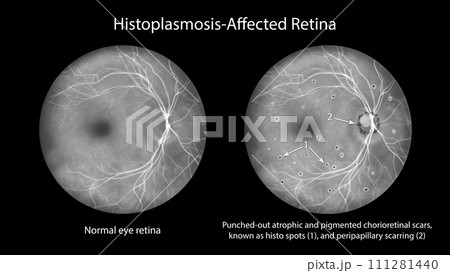 Retina in Ocular Histoplasmosis Syndrome, illustration 111281440