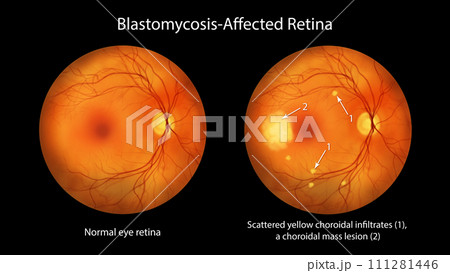 A blastomycosis-affected retina and a healthy retina, illustration 111281446