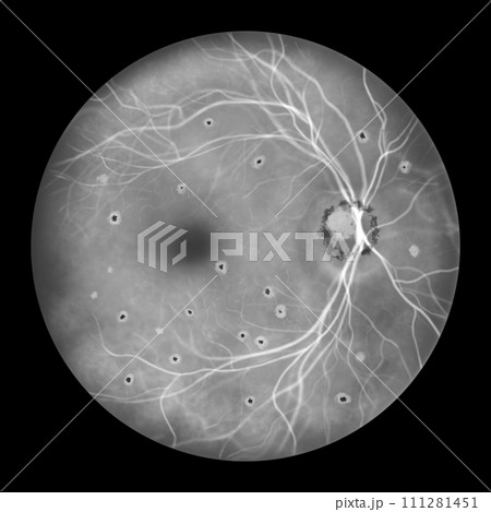 Retina in Ocular Histoplasmosis Syndrome, illustration Retina in Ocular Histoplasmosis Syndrome, illustration 111281451