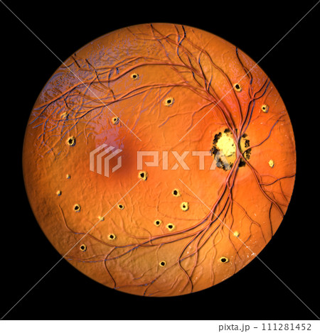 Retina in Ocular Histoplasmosis Syndrome, 3D illustration Retina in Ocular Histoplasmosis Syndrome, 3D illustration 111281452