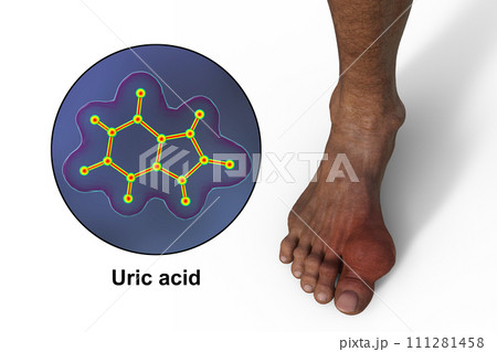 Gout-afflicted foot, 3D illustrationのイラスト素材 [111281458] - PIXTA
