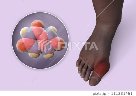 Gout-afflicted foot, 3D illustrationのイラスト素材 [111281461] - PIXTA