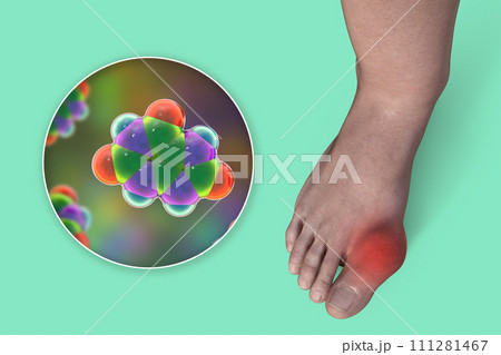 Gout-afflicted foot, 3D illustrationのイラスト素材 [111281467] - PIXTA